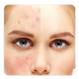 guide to Get rid of Acne1.1_Popularmodapk.com